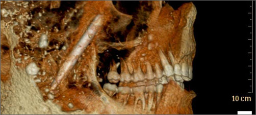 Зубы жителей Помпеи - фото
